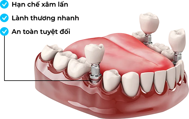 Trồng răng Implant tại Tâm An Dental