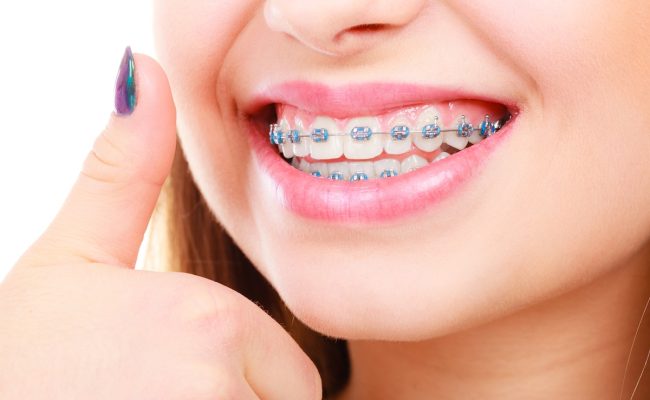 Niềng răng thẩm mỹ là gì