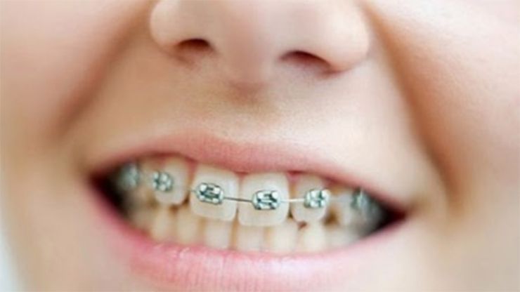 Niềng răng trẻ em